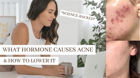 What Hormone Causes Acne On Chest